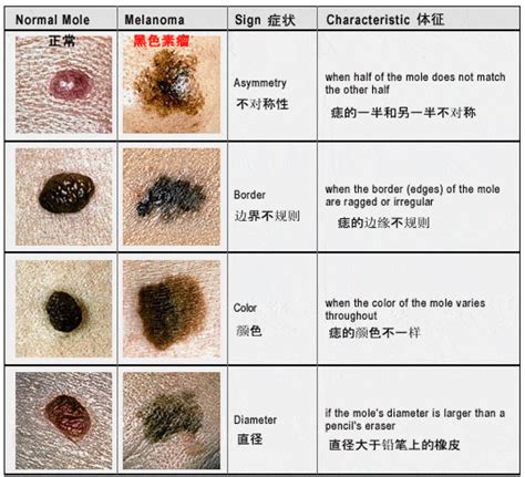 虎口突然長痣|痣也可能会癌变！长在 3 个地方要注意